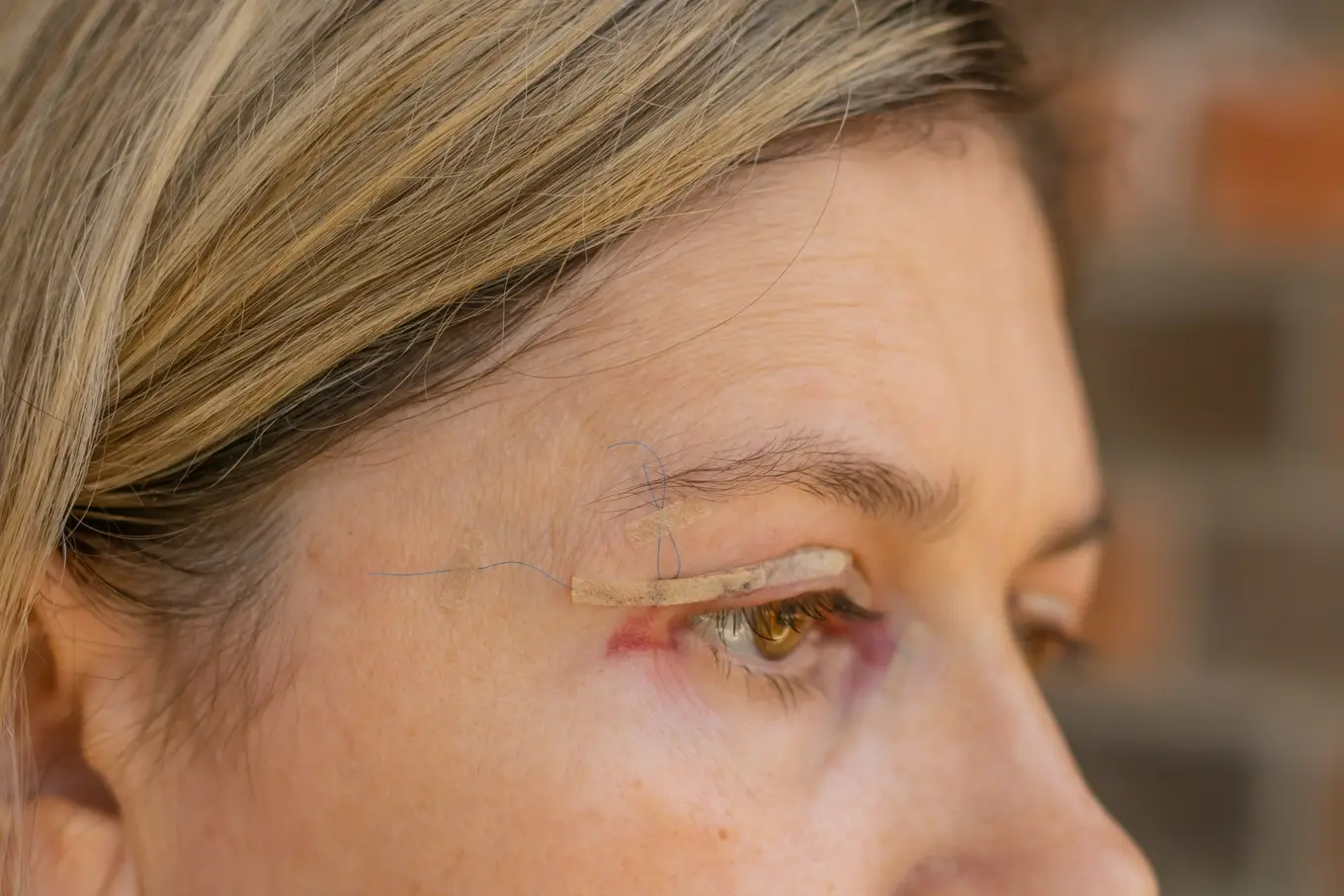 kobieta po zabiegu korekcji powiek